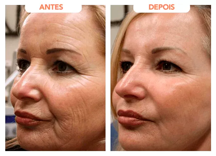 Fotos de antes e depois apresentadas no depoimento de Francisca